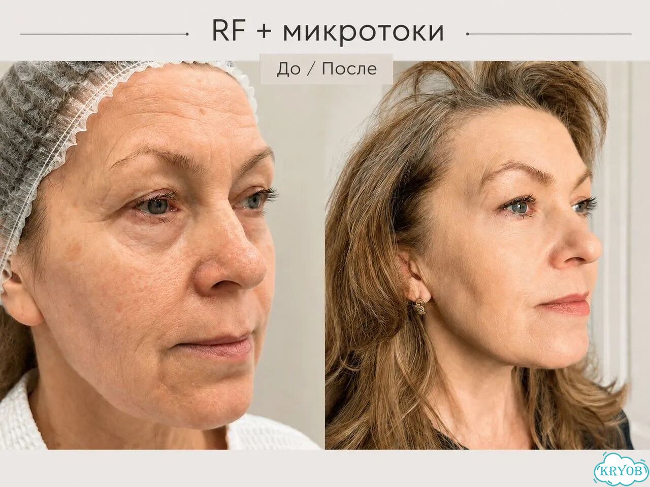Аппаратный уход для лица, RF лифтинг, микротоки фото 1